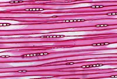 急性髓细胞白血病的临床表现是什么