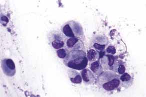 血小板减少一定会出血吗