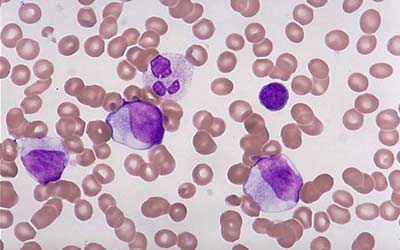 感染性血小板减少性紫癜为什么会发生