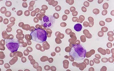 感染性血小板减少性紫癜为什么会发生